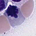 abnormal, purple-violet basophilic colored granules. Acute myeloid leukemias containing translocations of the MLL gene in the 11q23 region commonly present with monocytic/monoblastic morphology.
