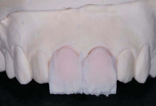 DESCRIPTION OF LAYERING OF CERAMIC A base shade of A1 was chosen with a slight A2 neck.