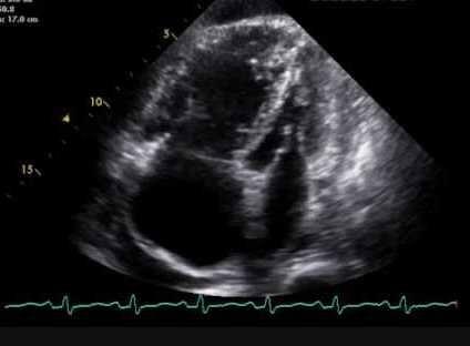 Diagnostic Testing If you suspect PH, start with a transthoracic echocardiogram (especially if signs of right heart