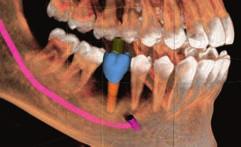 Customized abutments and screw-retained crowns can be easily and quickly produced.