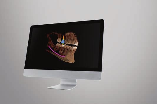 4 Impression The CEREC Omnicam can also make digital impressions of newly placed implants, saving patients the unpleasant experience associated with impression
