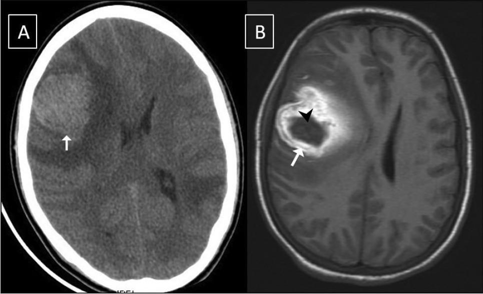 (A)CT hyperdense lesion in the right frontal lobe, peripheral edema (B) MRI T1w