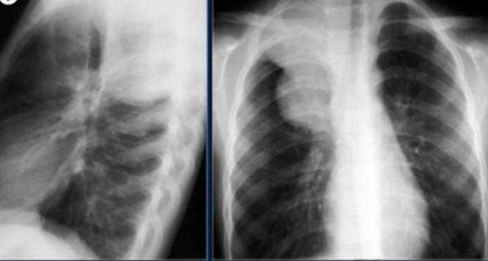 A PA and lateral X-rays reveal pulmonary