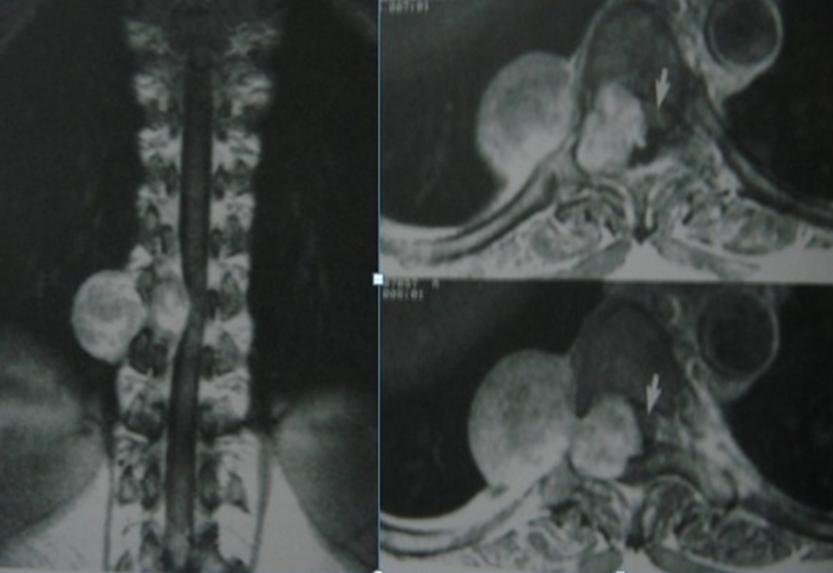 X-ray, AP projection welldefined homogeneous retrocardiac pulmonary