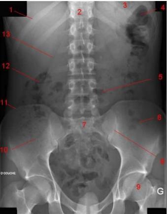 Gases in the sigmoid colon 6. Sacrum 7. Sacroiliac joints 8.