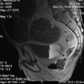 CE MRI, saggital view tumoral invasion of the upper 1/3 rectum, with