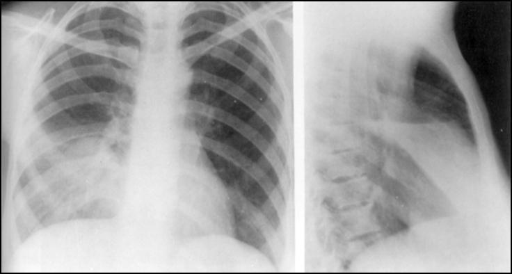 PATTERNS OF PNEUMONIA Lobar pneumonia The prototypical lobar pneumonia is pneumococcal pneumonia caused by Streptococcus pneumoniae.