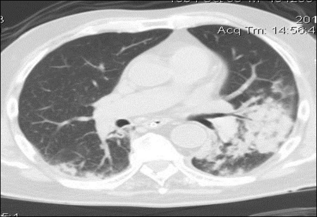CT FINDINGS- HOMOGENEOUS CONSOLIDATION OF