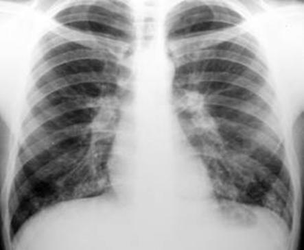 II. SEGMENTAL PNEUMONIA (BRONCHOPNEUMONIA) The prototypical bronchopneumonia is caused by