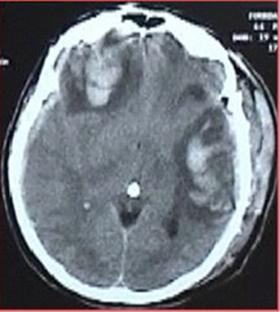 CT Method of choise in craniocerebral