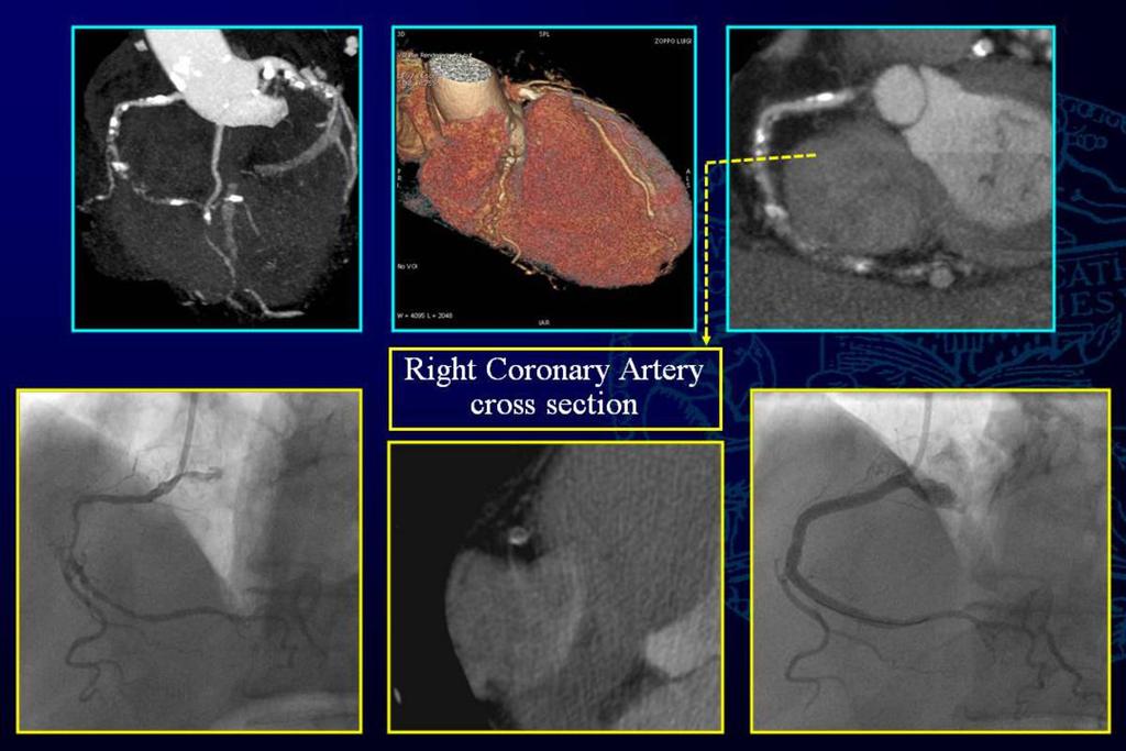 Fig. 8: Case 1: CO Patient, with CACS (Agatston)= 482 and a severe stenosis of mid Right Coronary Artery (RCA), well