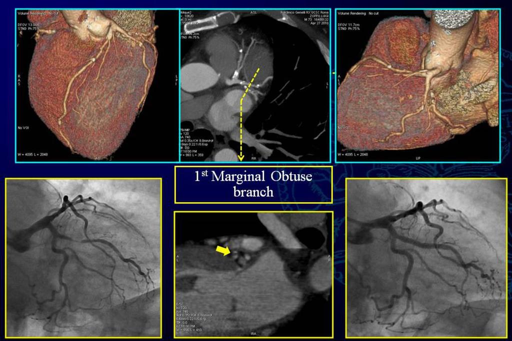 Fig. 9: Case 2: CO Patient with CACS (Agatston)= 1020 and a severe stenosis of a large first Marginal Obtuse (OM) branch,