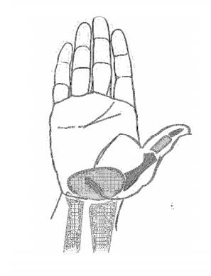 Arthritis at the Base of the Thumb Arthritis at the base of the thumb is a very common condition.