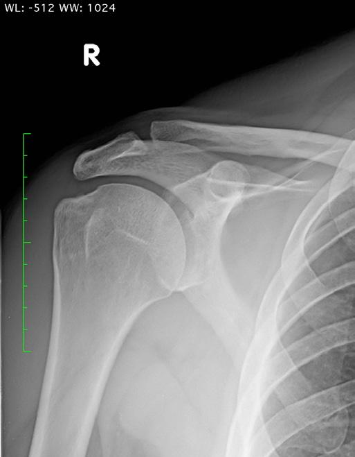 Does X-ray or MRI help? X-rays and/or MRI are sometimes used to rule out other causes of shoulder stiffness and pain, because frozen shoulder does not really show up on imaging.
