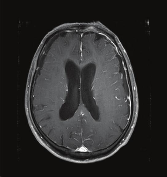 Case Reports in Emergency Medicine 3 (a) (b) Figure 1: Brain magnetic resonance imaging with contrast showed leptomeningeal enhancement without parenchymal lesion.