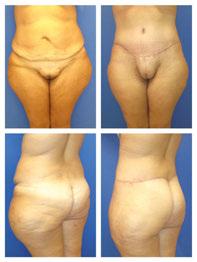 Body Contour Surgery in Massive Weight Loss Patients http://dx.doi.