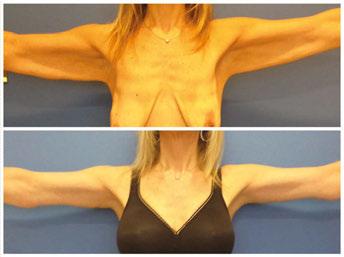 Body Contour Surgery in Massive Weight Loss Patients http://dx.doi.org/10.5772/64839 135 Figure 18.