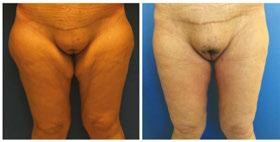 Body Contour Surgery in Massive Weight Loss Patients http://dx.doi.org/10.5772/64839 143 Figure 28.