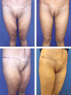 Some patients reach the upper knee so extension of the vertical extension is applied. Pre- and post-op. 5.