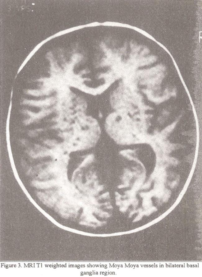 Circle of Willis was not visualized in all three patients who had CT scan.
