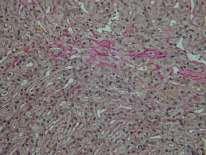 ificant fibrosis) on liver biopsy 4. No risk factors for chronic liver disease (e.g.