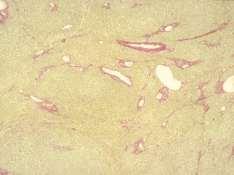 Non-cirrhotic portal fibrosis (India) Obliterative portal venopathy (Nayak 1979) Idiopathic Non- Cirrhotic Portal Hypertension (hepatoportal sclerosis) Pathogenesis + Histological Features Atrophy