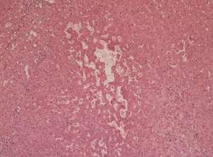7 Histological Assessment of Liver Disease Main Patterns of Liver Damage Sinusoidal dilatation ( megasinusoids ) Can produce changes mimicking: Peliosis hepatis (Berzigotti 2006) Venous outflow