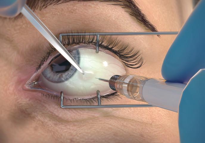 18 mg implant does not fall out of the applicator STEP 9 Gently displace the conjunctiva so that after withdrawing the needle, the conjunctival and scleral