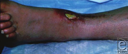 eplasty VOLUME 14 resulted in a 6 6cm 2 ulcer with exposed tibialis anterior tendon. Initially, the wound was managed conservatively with debridement and local wound care.