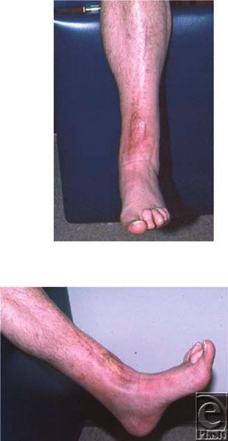 eplasty VOLUME 14 perforating branch of peroneal artery, 8 bipedal fasciocutaneous flap, distal flaps based on septocutaneous perforators of the posterior tibial 9 or peroneal artery, 10 and random
