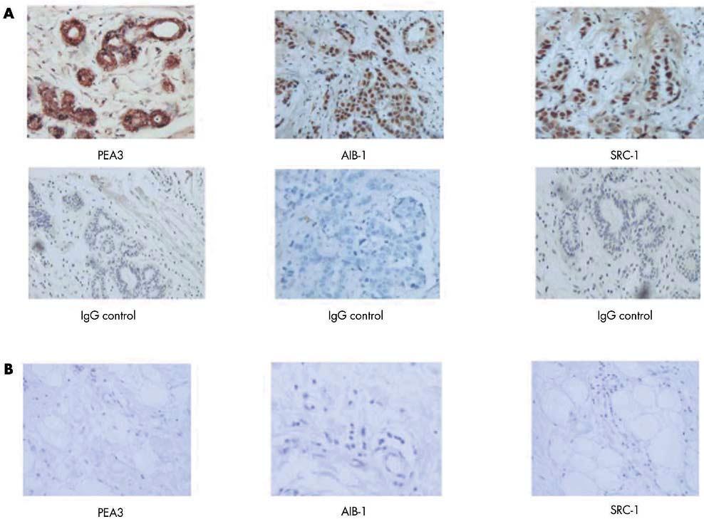 Coactivators in HER2 mediated breast cancer 1071 Figure 1 PEA3, AIB1, and SRC-1 protein expression in paraffin wax embedded invasive breast carcinoma and normal breast tissue specimens.