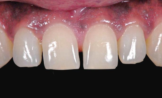 The periodontal tissues of this patient were healthy and the maxillary incisors did not show any sign of decay, but had unfavourable shapes and proportions leading to spacing in the anterior area.
