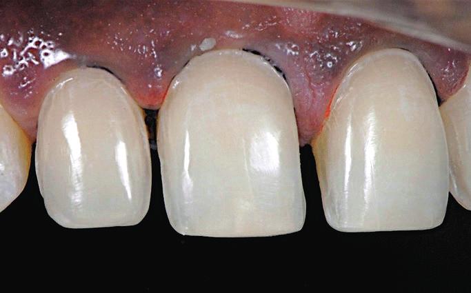 This reduction through the mock-up using calibrated burs enables the clinician to control the depth of preparation and thus keep the preparation in the enamel of the teeth.