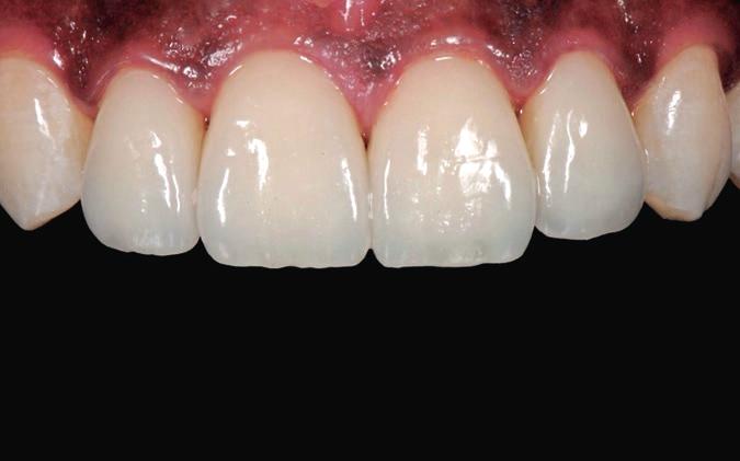 Their fit and the shade match obtained with the adjacent teeth was perfect, so that no adjustments were necessary. The teeth were isolated and then cleaned using the 3M CoJet System.