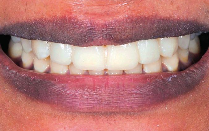 The aim of balancing dental and facial aesthetics was reached with the placement of four veneers. Figure 11: Treatment result.