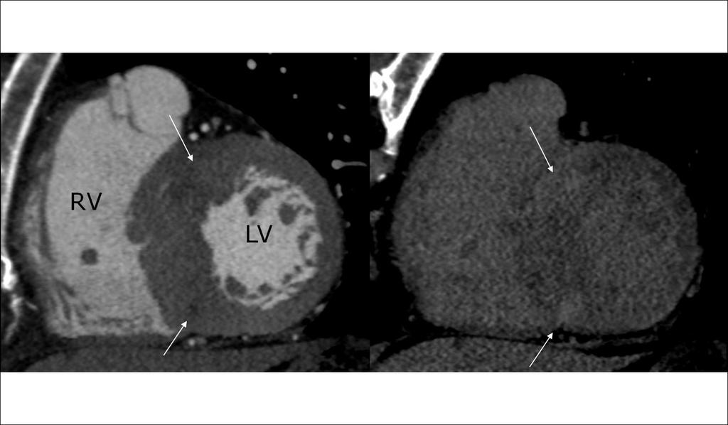 Typical 320 Slice CT Images of myocardial fibrosis