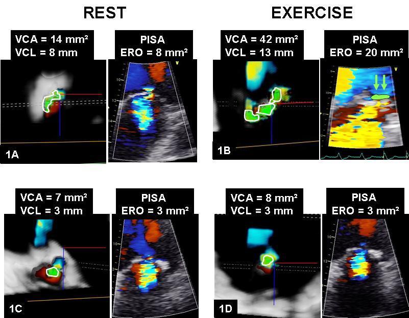 Results Indices to assess FMR at rest and during exercise FMR increase (n=24) MR stable (n=36) p value 3D-VCA (mm²) Rest Exe 17 ± 5 42 ± 7 *** 11 ± 7 15 ± 7 * < 0.001 < 0.