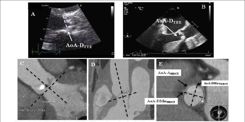 Aortic Cardiac Annulus Event-free Area Assessment by Survival MDCT for Predicting according Paravalvular to Ex-PHT Regurgitation in Patients undergoing TAVI Aim of the study To compare the