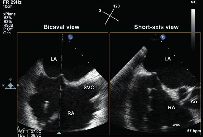 Clinical value for surgical and interventional cardiology The irotate images acquired during TEE are identical to the images acquired with a traditional TEE transducer, except the steering mechanism
