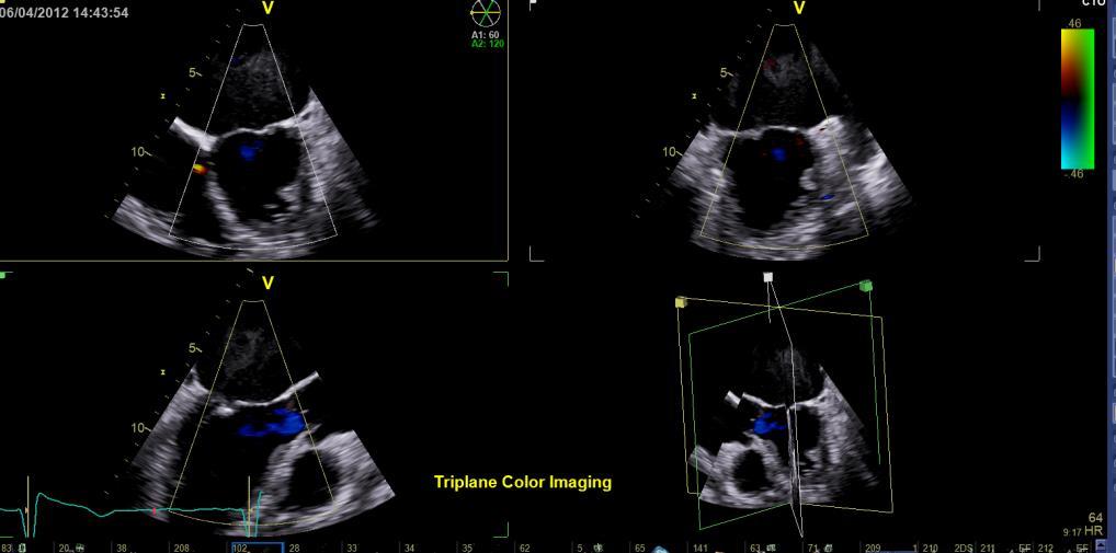 3D volume visualization of mitral valve, aortic valve and cardiac sections provide insight into