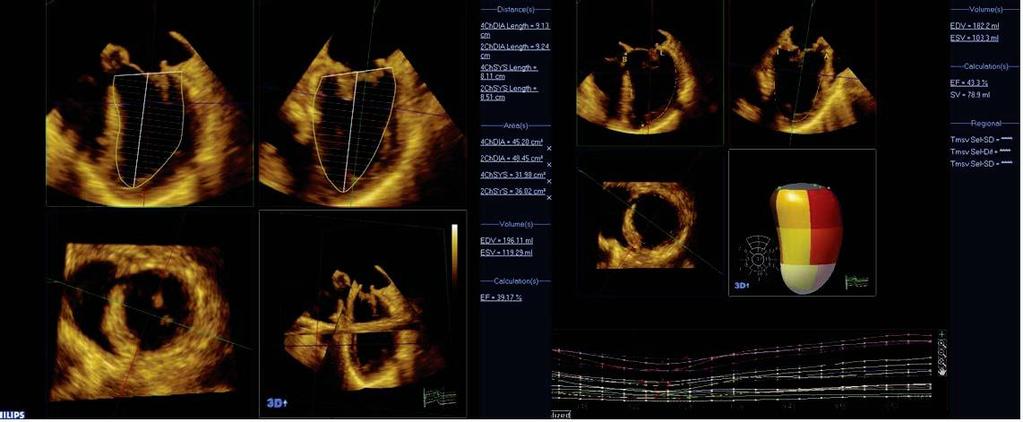 Philips 3DQ Left Ventricular 2D Model Philips 3DQ Advanced Left Ventricular 3D Model Mitral Valve 3D echo of the mitral valve is superb for obtaining basic views or defining advanced images in