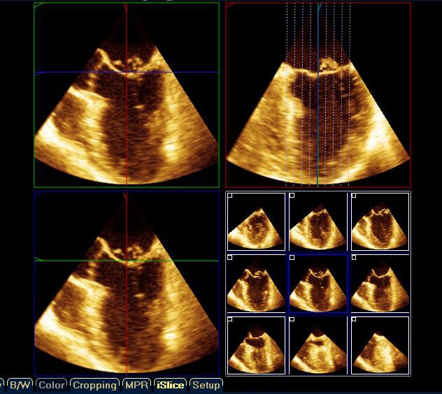 Mitral Valve MPR Multi-slice All vendors provide the ability to multi-slice the 3D volumes from a 2D MPR image. This is very helpful in examining the mitral valve.