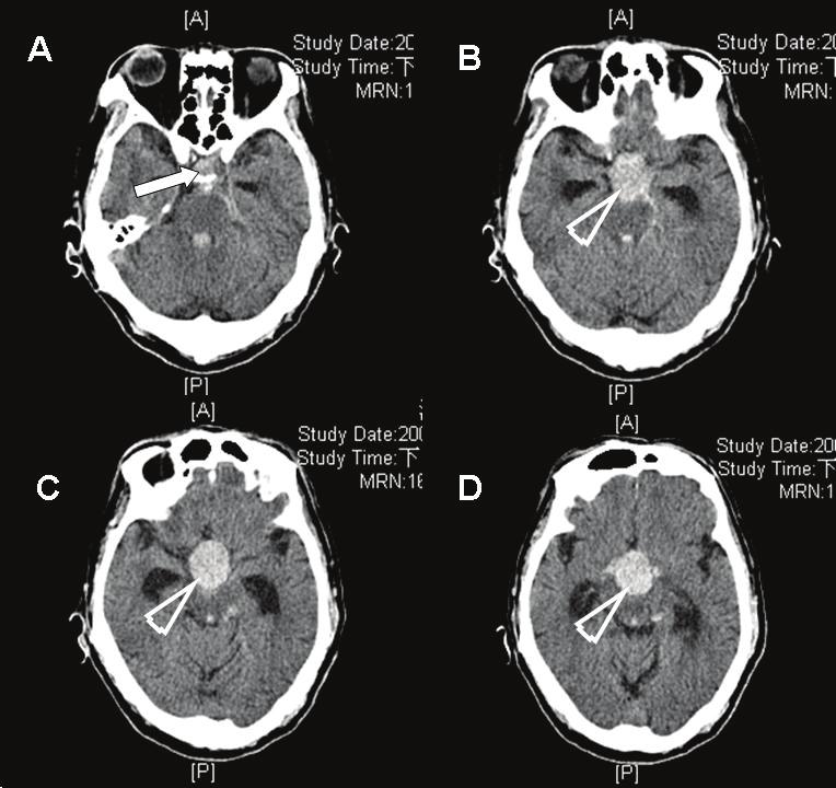 456 J. H. Tseng et al./jcos 25(2009) 454-460 Figure 1. Brain CT without contrast enhancement discloses that, in addition to a well-demarcated hyperdense lesion (2.
