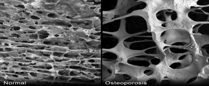OSTEOPOROSIS The Silent Thief Chronic, progressive metabolic bone disease marked by Low bone mass Deteriora?on of bone?