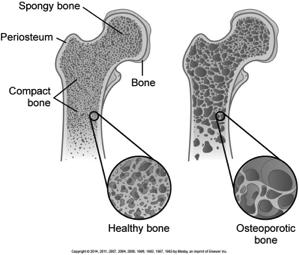 Remodeling Osteoblasts deposit bone Osteoclasts resorb bone In osteoporosis, bone resorp?