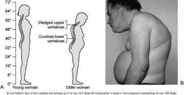 on Clinical Manifesta4ons Occurs most commonly in spine, hips, and wrists Back pain Spontaneous fractures