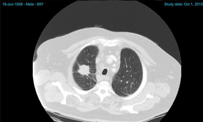 Lung Cancer Case 1 Mr JN aged 85 years Presented with mild