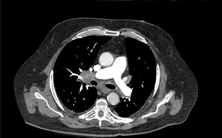 CT scan showed right apical lung lesion Abnormal