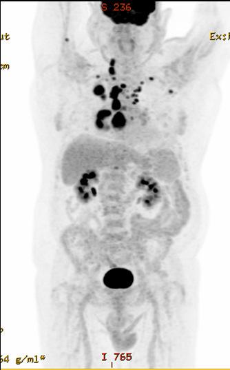 Abnormal appearance of pancreatic tail