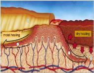 remodeling of scar MMs in Normal Wound Healing MMs are essential for normal wound healing, BUT must be: At the right places At the right times At the